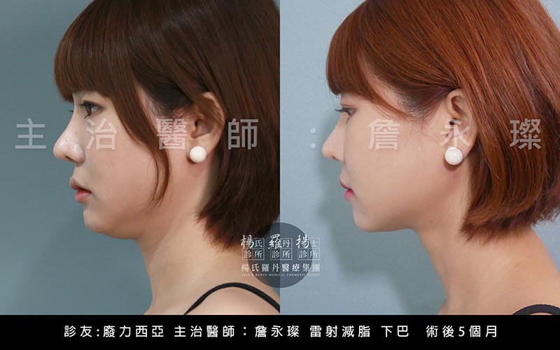 雷射減脂,楊氏羅丹,詹永璨,鄭源,賴斯敏,塑身,曲線,抽脂