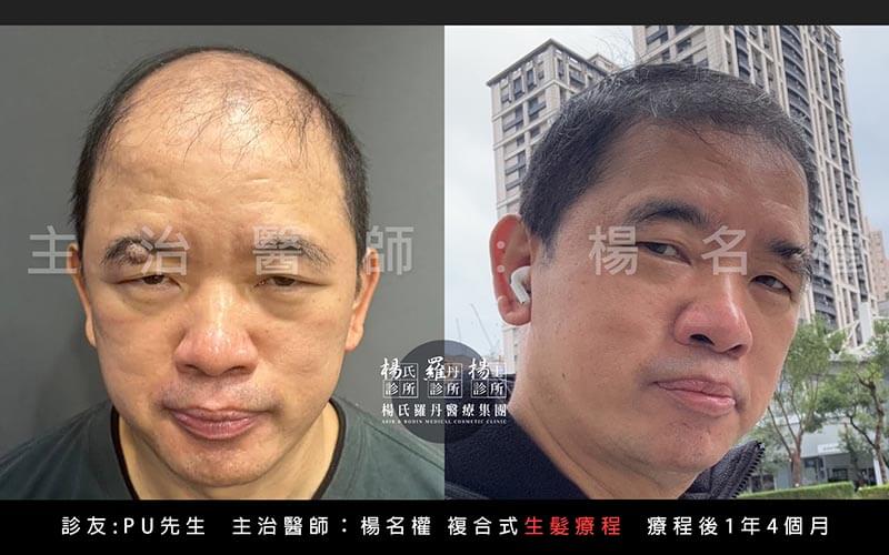 楊名權,植髮,生髮,禿頭,雄性禿,楊氏羅丹,生髮2